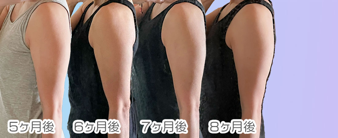 フィットボクシングを始めて5ヶ月目から8ヶ月目までの二の腕の写真